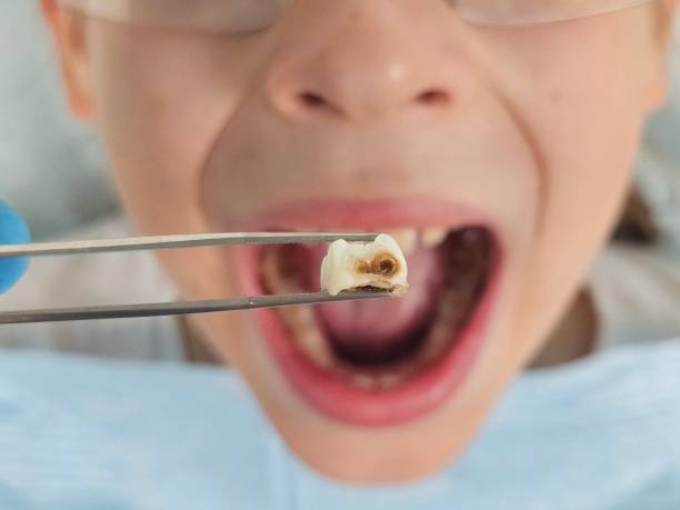 Best Emergency Treatment for Toothache in Silver Lake, NC